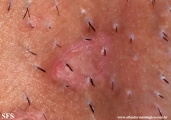 porokeratosis-inguinal_porokeratosis