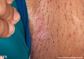 porokeratosis-inguinal_porokeratosis