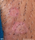 porokeratosis-inguinal_porokeratosis