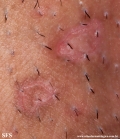 porokeratosis-inguinal_porokeratosis