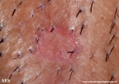 porokeratosis-inguinal_porokeratosis