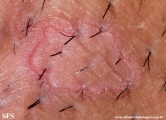 porokeratosis-inguinal_porokeratosis