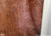 porokeratosis-inguinal_porokeratosis