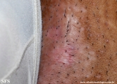 porokeratosis-inguinal_porokeratosis