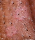porokeratosis-inguinal_porokeratosis