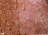 porokeratosis-inguinal_porokeratosis
