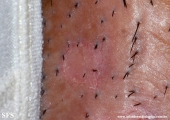 porokeratosis-inguinal_porokeratosis