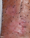 porokeratosis-inguinal_porokeratosis