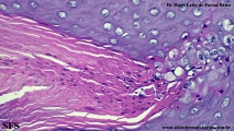porokeratosis-inguinal_porokeratosis