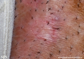 porokeratosis-inguinal_porokeratosis
