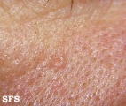 sebaceous gland hyperplasia