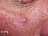 sebaceous gland hyperplasia