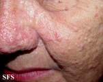 sebaceous gland hyperplasia
