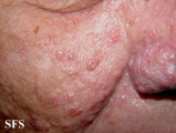 sebaceous gland hyperplasia