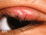 hordeoli and pediculosis palpebrarum