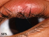 hordeoli and pediculosis palpebrarum