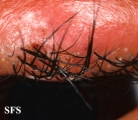 hordeoli and pediculosis palpebrarum