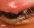 hordeoli and pediculosis palpebrarum