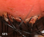 hordeoli and pediculosis palpebrarum