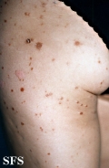pityriasis lichenoides chronica