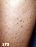 pityriasis lichenoides chronica