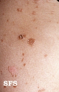 pityriasis lichenoides chronica