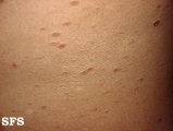 pityriasis lichenoides chronica