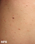 pityriasis lichenoides chronica