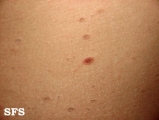 pityriasis lichenoides chronica