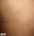 pityriasis lichenoides chronica