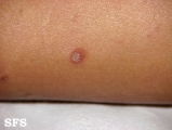 pityriasis lichenoides chronica