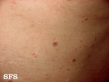pityriasis lichenoides chronica