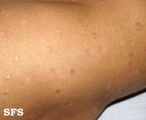 pityriasis lichenoides chronica