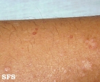 pityriasis lichenoides chronica