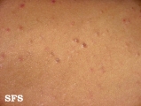 pityriasis lichenoides chronica