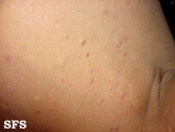 pityriasis lichenoides chronica
