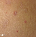 pityriasis lichenoides chronica