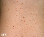 pityriasis lichenoides chronica