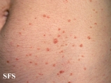 pityriasis lichenoides chronica