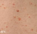 pityriasis lichenoides chronica