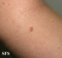 pityriasis lichenoides chronica