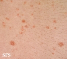 pityriasis lichenoides chronica