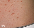 pityriasis lichenoides chronica
