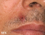 pilomatricoma-perforanting pilomatricoma