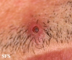 pilomatricoma-perforanting pilomatricoma