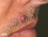 pilomatricoma-perforanting pilomatricoma
