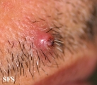 pilomatricoma-perforanting pilomatricoma