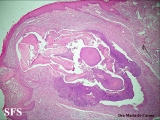 pilomatricoma-perforanting pilomatricoma