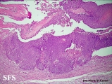 pilomatricoma-perforanting pilomatricoma