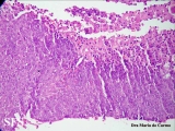 pilomatricoma-perforanting pilomatricoma
